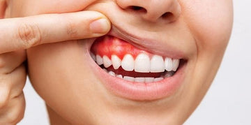 De ce apar sângerările gingivale? Cauze și soluții